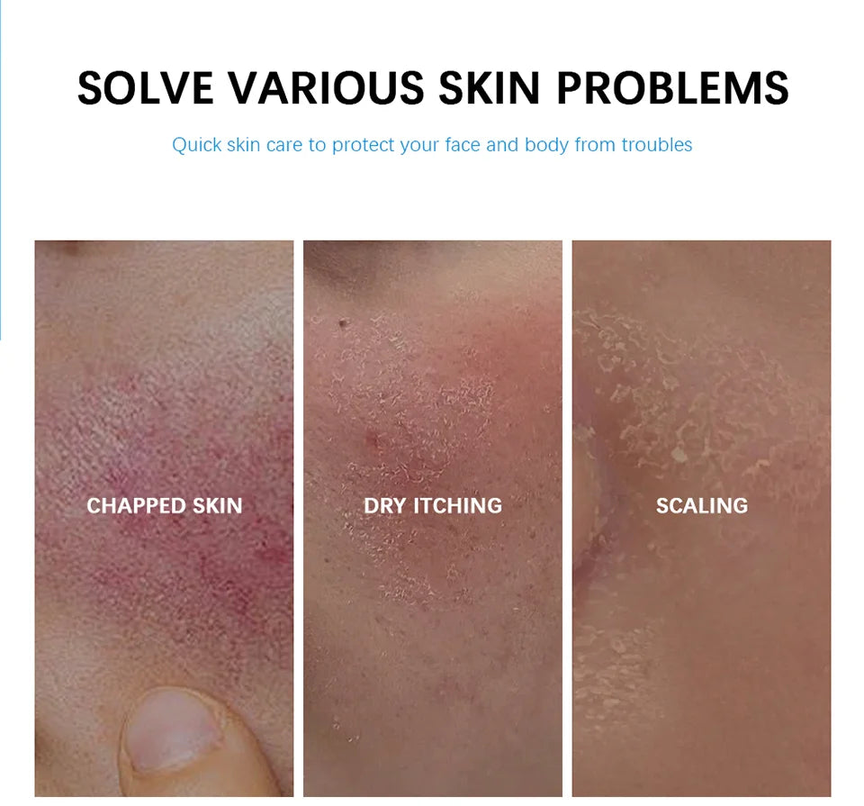 Soothing Multi-Purpose Hydrating Cream Reduces Redness Daily Helps Relieve Rough Cracked Skin Deep Skin Care